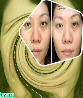 Concealer for rosacea