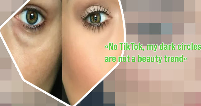 Dark under eye trend